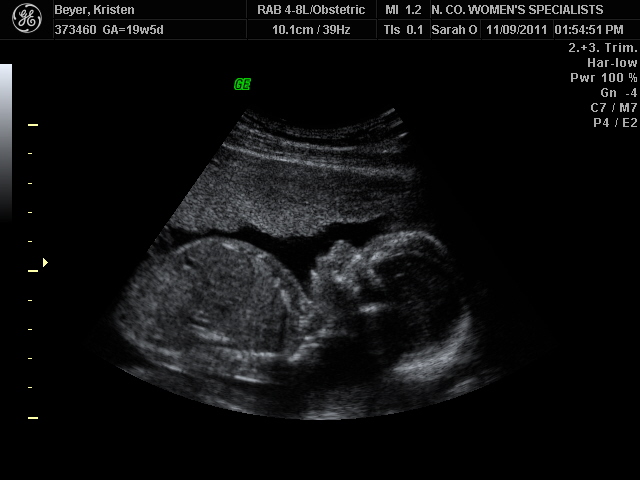 Ultrasound Sonogram Jonah Ultrasound Sonogram Jonah